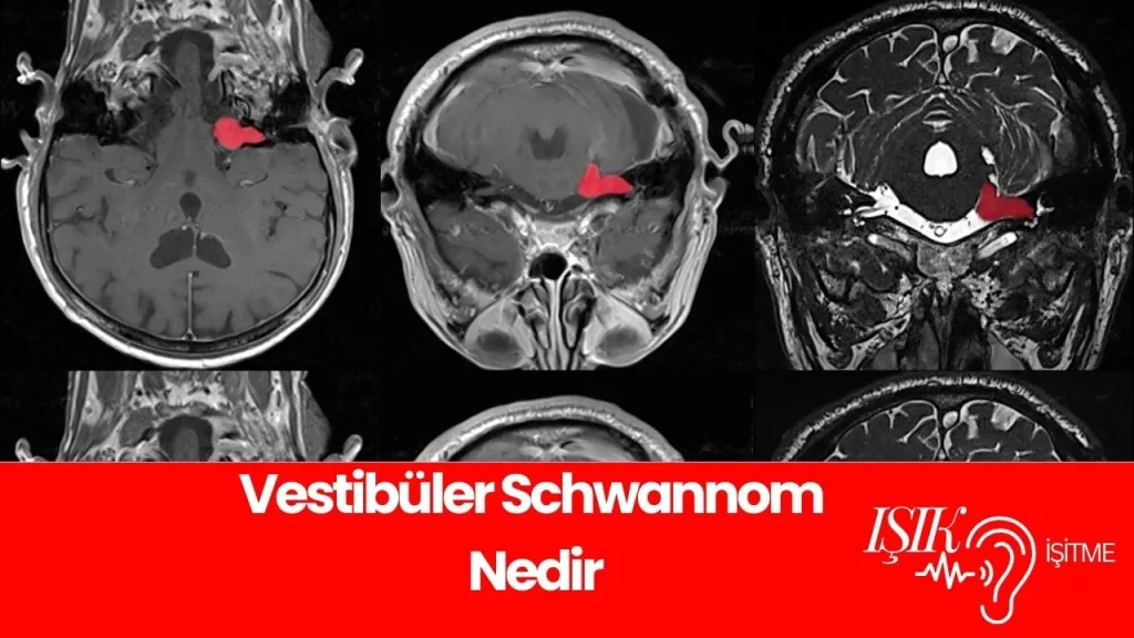 vestibuler schwannom nedir